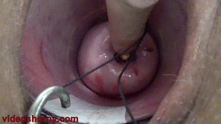Uterus Penetration with Objects,Pumping Cervix Prolapse